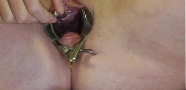  Analslut Filled with her own piss in speculum gaping pussy.  Urethra stretched with sounds - biggest yet, 10mm